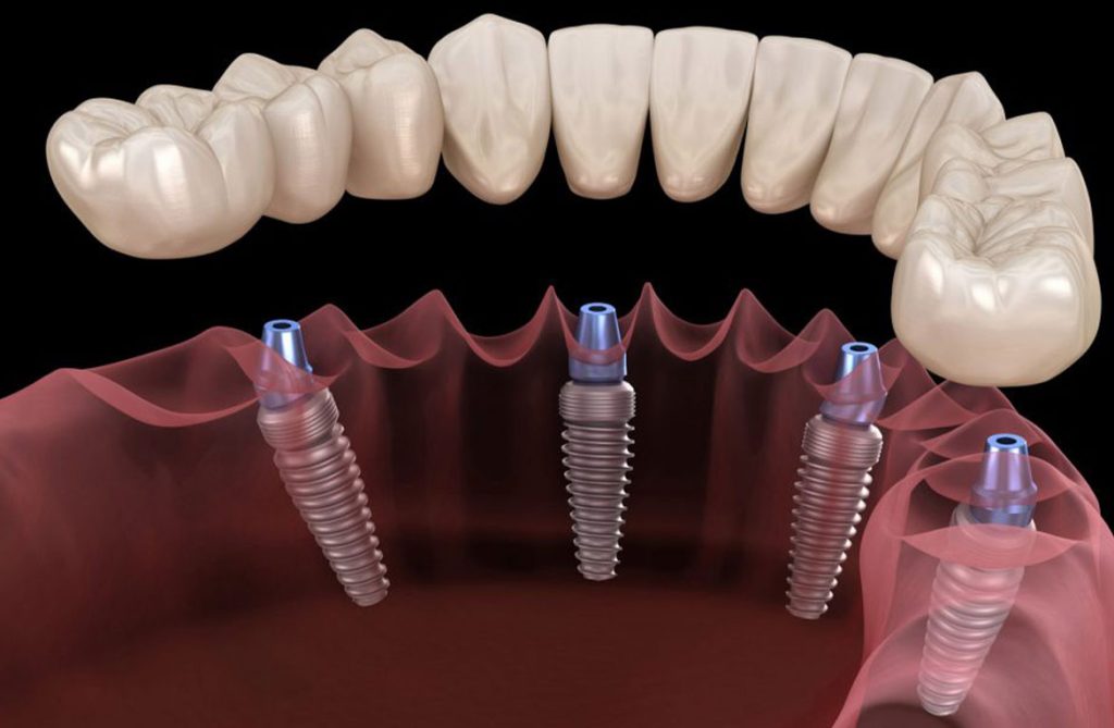 Dental Implants