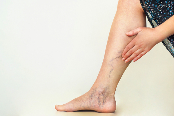 Spider Veins
